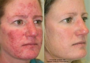 rosacea before and after