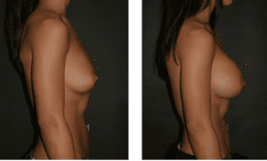 breast augmentation suirgery before and after