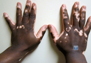 treating vitiligo