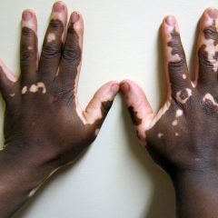 Non-segmental vitiligo of the hand