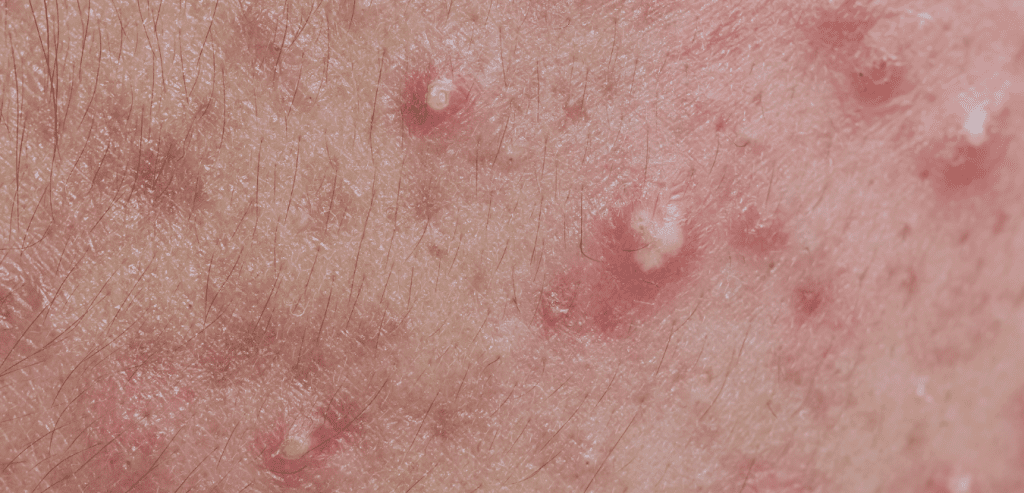 pustule acne causes and treatment options