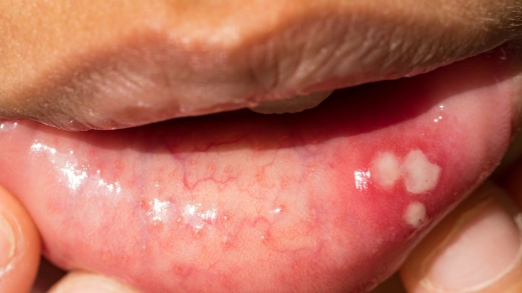 Cankers Sores Causes Symptoms And Treatment Options