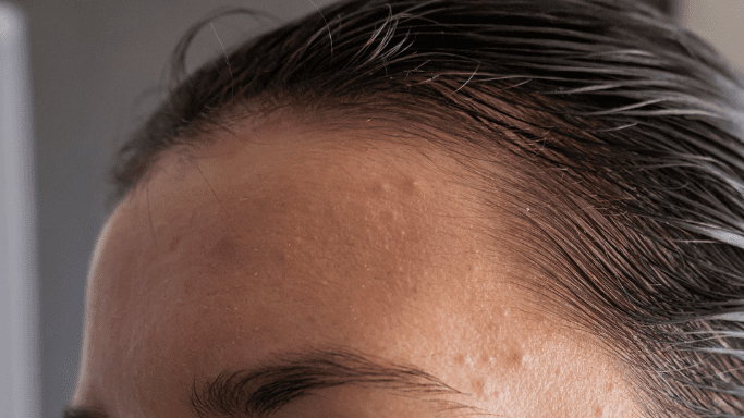How to Treat Zits And Pimples