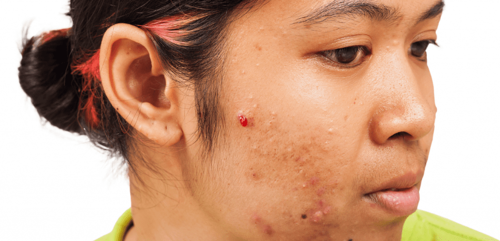 cystic acne on the cheek