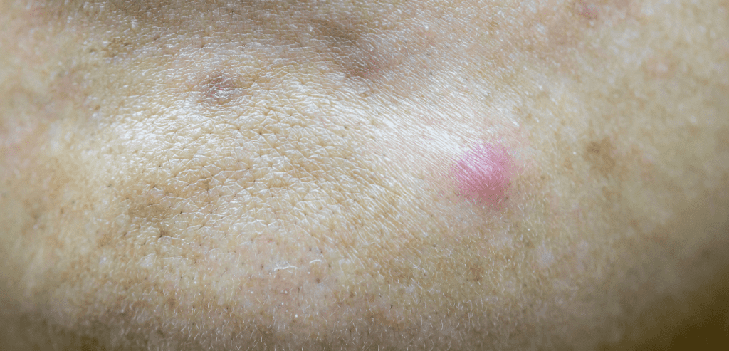 cystic acne on the chin