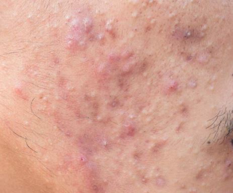 fungal acne infection