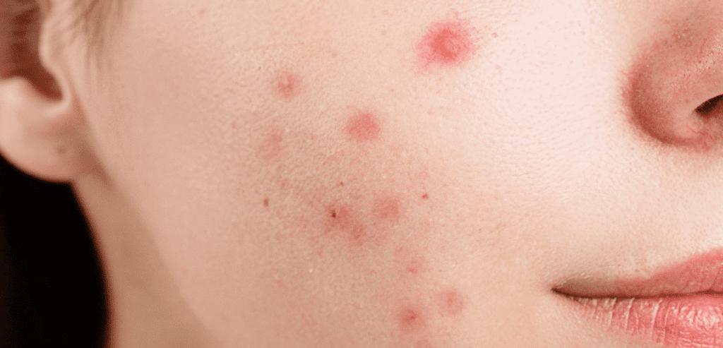 Fungal Acne Causes Symptoms and Treatment Option