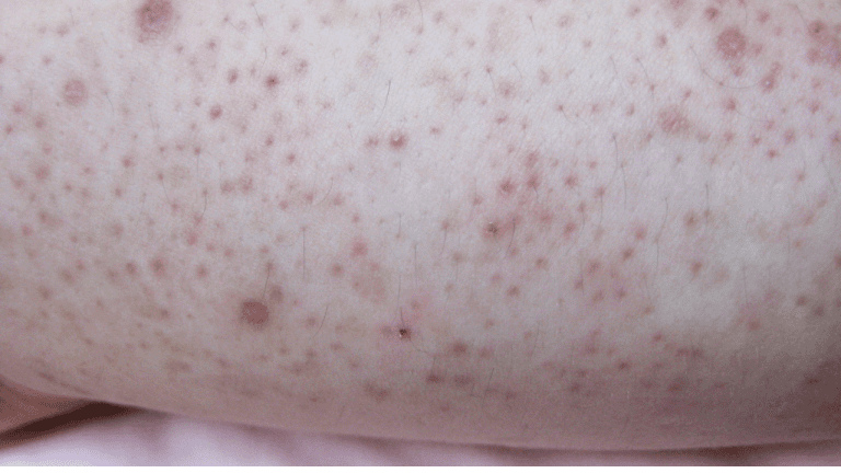 Keratosis Pilaris Symptoms Causes And Treatment Options