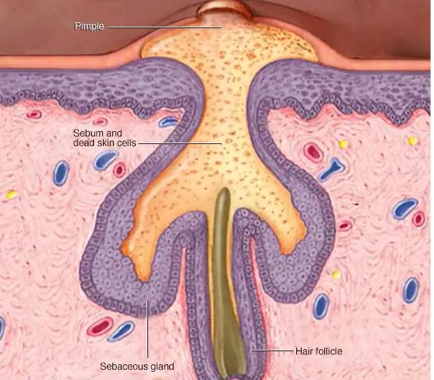 Anatomy Of A Pimple Diagram