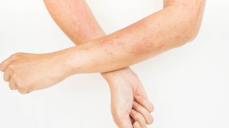 Contact Dermatitis Causes Diagnosis and Treatment Options