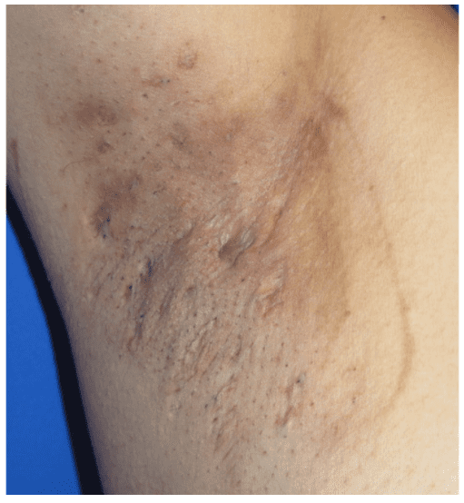 Hidradenitis Suppurativa causes types prevention tips and treatment options