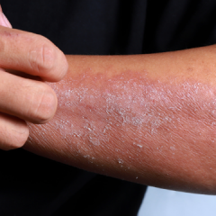 Tips to Help With Your Eczema