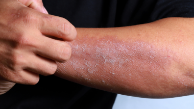 Tips to Help With Your Eczema
