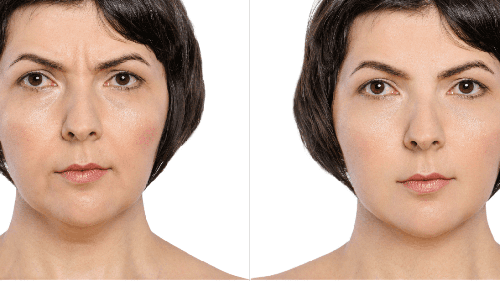 before and after botox anti-age therapy