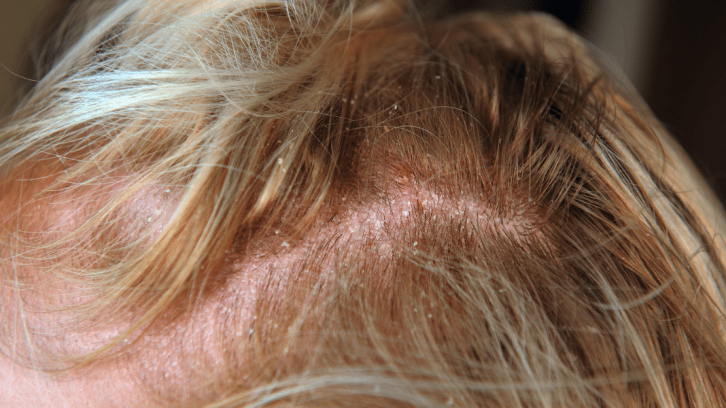 contact dermatitis scalp treatment options,